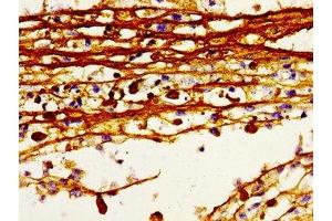 Immunohistochemistry of paraffin-embedded human melanoma using ABIN7155249 at dilution of 1:100 (HDC antibody  (AA 504-648))