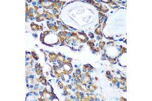 Immunohistochemistry of paraffin-embedded Human thyroid cancer using PDXDC1 Rabbit pAb (ABIN7269759) at dilution of 1:100 (40x lens). (PDXDC1 antibody  (AA 489-788))