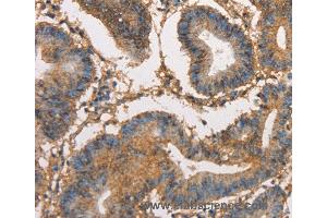 Immunohistochemistry of Human thyroid cancer using HK3 Polyclonal Antibody at dilution of 1:40