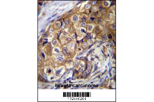 CTAGE5 Antibody immunohistochemistry analysis in formalin fixed and paraffin embedded human breast carcinoma followed by peroxidase conjugation of the secondary antibody and DAB staining.