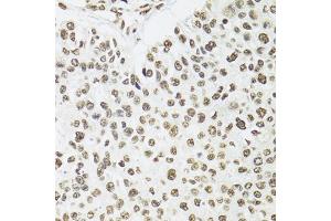 Immunohistochemistry of paraffin-embedded human esophageal cancer using SFPQ antibody (ABIN5970351) at dilution of 1/100 (40x lens). (SFPQ antibody)
