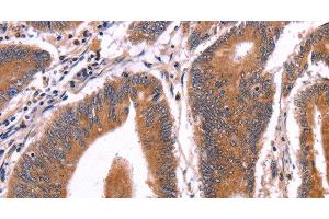 Immunohistochemistry of paraffin-embedded Human colon cancer tissue using CRISP3 Polyclonal Antibody at dilution 1:50 (CRISP3 antibody)