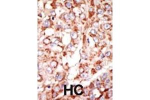 Formalin-fixed and paraffin-embedded human cancer tissue reacted with the primary antibody, which was peroxidase-conjugated to the secondary antibody, followed by DAB staining. (Acsl3 antibody  (N-Term))