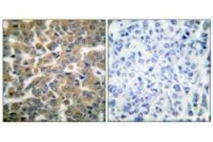 Immunohistochemical analysis of paraffin-embedded human breast carcinoma tissue using GR (Ab-211) antibody. (Glucocorticoid Receptor antibody  (Ser211))