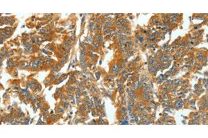 Immunohistochemistry of paraffin-embedded Human gastric cancer using ASNS Polyclonal Antibody at dilution of 1:60 (Asparagine Synthetase antibody)