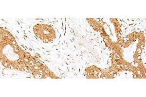 Immunohistochemistry of paraffin-embedded Human breast cancer tissue using GOLGA7 Polyclonal Antibody at dilution of 1:40(x200) (Golgin A7 antibody)