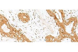 Immunohistochemistry of paraffin-embedded Human breast cancer tissue using GOLGA7 Polyclonal Antibody at dilution of 1:40(x200)