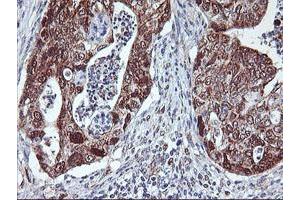 Immunohistochemical staining of paraffin-embedded Carcinoma of Human pancreas tissue using anti-NLN mouse monoclonal antibody. (NLN antibody)