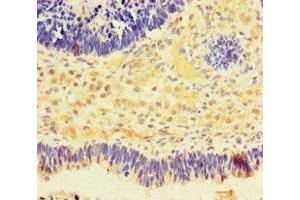 Immunohistochemistry of paraffin-embedded human ovarian cancer using ABIN7161580 at dilution of 1:100 (NMNAT2 antibody  (AA 1-153))