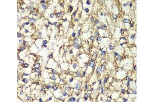 Immunohistochemistry of paraffin-embedded Human kidney cancer using PTGES2 Polyclonal Antibody at dilution of 1:100 (40x lens). (PTGES2 antibody)