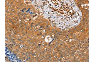 The image on the left is immunohistochemistry of paraffin-embedded Human cervical cancer tissue using ABIN7128162(ACOT11 Antibody) at dilution 1/25, on the right is treated with fusion protein. (ACOT11 antibody)