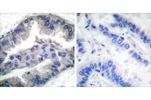 P-peptide - +Immunohistochemical analysis of paraffin-embedded human lung carcinoma tissue using BIK (Phospho-Thr33) antibody (#A0053). (BIK antibody  (pThr33))