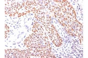 Formalin-fixed, paraffin-embedded Lung Squamous Cell Carcinoma stained with p40 Rabbit Polyclonal Antibody. (p63 antibody  (AA 5-17))
