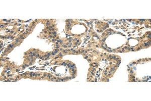 Immunohistochemistry of paraffin-embedded Human thyroid cancer tissue using TMPRSS11E Polyclonal Antibody at dilution 1:45 (TMPRSS11E antibody)