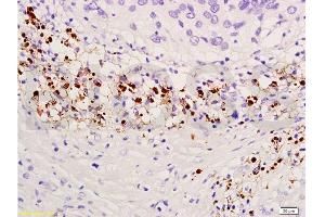 Formalin-fixed and paraffin embedded human endometrium carcinoma labeled with Anti-TIMP-4 Polyclonal Antibody, Unconjugated  at 1:300, followed by conjugation to the secondary antibody and DAB staining (TIMP4 antibody  (AA 161-224))