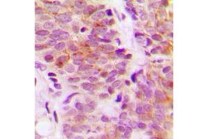 Immunohistochemical analysis of S6K1 staining in human breast cancer formalin fixed paraffin embedded tissue section.
