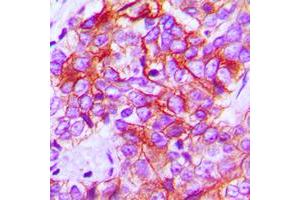 Immunohistochemical analysis of CD95 staining in human breast cancer formalin fixed paraffin embedded tissue section.