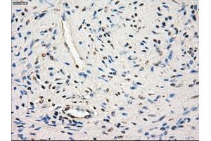 Immunohistochemical staining of paraffin-embedded endometrium tissue using anti-SLC2A6mouse monoclonal antibody. (SLC2A6 antibody)