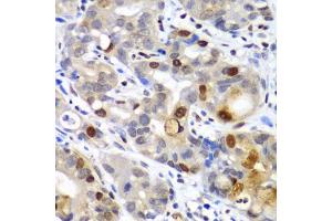 Immunohistochemistry of paraffin-embedded human gastric cancer using SUMO2 antibody (ABIN6128719, ABIN6148726, ABIN6148728 and ABIN6218594) at dilution of 1:100 (40x lens). (SUMO2 antibody  (AA 1-95))