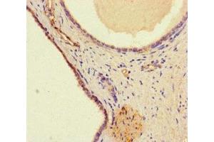 Immunohistochemistry of paraffin-embedded human prostate cancer using ABIN7175714 at dilution of 1:100 (WDFY4 antibody  (AA 1-322))