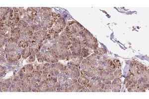 ABIN6273284 at 1/100 staining Human pancreas cancer tissue by IHC-P.