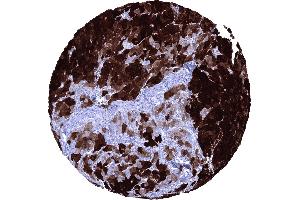Hepatocellular carcinoma with strong FABP1 immunostaining of _95 of tumor cells (FABP1 antibody  (AA 1-127))