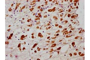 IHC image of ABIN7127713 diluted at 1:100 and staining in paraffin-embedded human melanoma cancer performed on a Leica BondTM system. (Recombinant MLKL antibody  (pSer358))