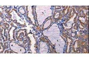 Immunohistochemistry of paraffin-embedded Human thyroid cancer using DRD1 Polyclonal Antibody at dilution of 1:50 (Dopamine Receptor d1 antibody)