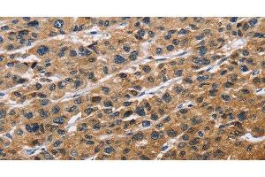 Immunohistochemistry of paraffin-embedded Human liver cancer tissue using EIF4EBP2 Polyclonal Antibody at dilution 1:40 (eIF4EBP2 antibody)