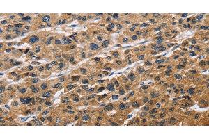 Immunohistochemistry of paraffin-embedded Human liver cancer tissue using EIF4EBP2 Polyclonal Antibody at dilution 1:40