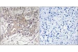 Immunohistochemistry analysis of paraffin-embedded human liver carcinoma tissue, using GCNT3 Antibody. (GCNT3 antibody  (AA 226-275))