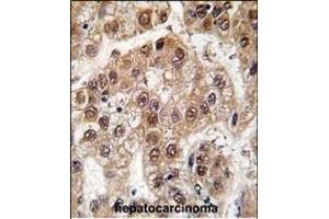 Formalin-fixed and paraffin-embedded human hepatocarcinoma tissue reacted with U2AF1 antibody (Center S70), which was peroxidase-conjugated to the secondary antibody, followed by DAB staining. (U2AF1 antibody  (AA 55-83))
