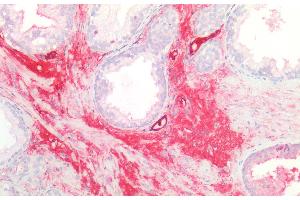 Detection of GLMP in Human Prostate Tissue using Polyclonal Antibody to Glycosylated Lysosomal Membrane Protein (GLMP) (C1orf85 antibody  (AA 246-404))