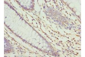 Immunohistochemistry of paraffin-embedded human colon cancer using ABIN7176235 at dilution of 1:100 (ZNF324 antibody  (AA 1-270))