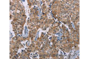 Immunohistochemistry of Human breast cancer using PLXNA4 Polyclonal Antibody at dilution of 1:50