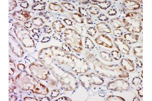 Formalin-fixed and paraffin embedded human kidney cancer labeled with CBY1 Polyclonal Antibody, Unconjugated  at 1:200 followed by conjugation to the secondary antibody and DAB staining (CBY1/PGEA1 antibody  (AA 51-126))