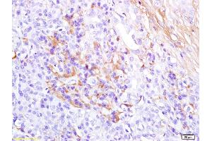 Formalin-fixed and paraffin embedded human pancreas carcinoma labeled with Anti-Glucagon Polyclonal Antibody, Unconjugated (ABIN704246) at 1:200 followed by conjugation to the secondary antibody and DAB staining (Glucagon antibody  (AA 53-81))