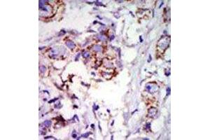 Formalin-fixed and paraffin-embedded human cancer tissue reacted with the primary antibody, which was peroxidase-conjugated to the secondary antibody, followed by DAB staining. (GRK6 antibody  (C-Term))