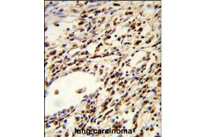 Formalin-fixed and paraffin-embedded human lung carcinoma reacted with FLCN Antibody , which was peroxidase-conjugated to the secondary antibody, followed by DAB staining. (FLCN antibody  (AA 325-354))