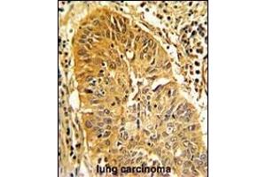 Formalin-fixed and paraffin-embedded human lung carcinoma with CALD1 Antibody (Center), which was peroxidase-conjugated to the secondary antibody, followed by DAB staining. (Caldesmon antibody  (AA 428-457))