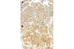 Immunohistochemical staining (Formalin-fixed paraffin-embedded sections) of human renal cell carcinoma with EPCAM polyclonal antibody . (EpCAM antibody)