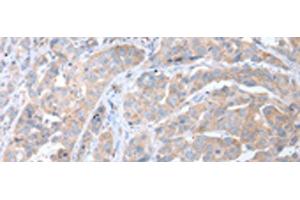 Immunohistochemistry of paraffin-embedded Human breast cancer tissue using ATG16L1 Polyclonal Antibody at dilution of 1:40(x200) (ATG16L1 antibody)