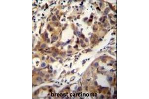 CCDC17 antibody (C-term) (ABIN654991 and ABIN2844627) immunohistochemistry analysis in formalin fixed and paraffin embedded human breast carcinoma followed by peroxidase conjugation of the secondary antibody and DAB staining. (CCDC17 antibody  (C-Term))