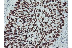 Immunohistochemical staining of paraffin-embedded Carcinoma of Human lung tissue using anti-TP53 mouse monoclonal antibody. (p53 antibody)