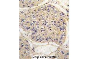 Formalin-fixed and paraffin-embedded human lung carcinoma tissue reacted with FKBP12 antibody (Center) (ABIN392172 and ABIN2841886) , which was peroxidase-conjugated to the secondary antibody, followed by DAB staining. (FKBP1A antibody  (AA 43-74))