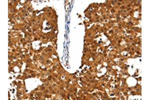 The image on the left is immunohistochemistry of paraffin-embedded Human breast cancer tissue using ABIN7192661(SSTR5 Antibody) at dilution 1/30, on the right is treated with synthetic peptide. (SSTR5 antibody)