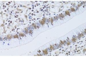 Immunohistochemistry of paraffin-embedded Human gastric cancer using LMNB2 Polyclonal Antibody at dilution of 1:100 (40x lens). (Lamin B2 antibody)