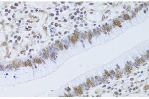 Immunohistochemistry of paraffin-embedded Human gastric cancer using LMNB2 Polyclonal Antibody at dilution of 1:100 (40x lens).