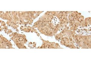 Immunohistochemistry of paraffin-embedded Human liver cancer tissue using ZNF24 Polyclonal Antibody at dilution of 1:35(x200) (ZNF24 antibody)