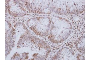 IHC-P Image STK24 antibody [N2C1], Internal detects STK24 protein at cytosol and nucleus on human breast carcinoma by immunohistochemical analysis. (STK24 antibody)